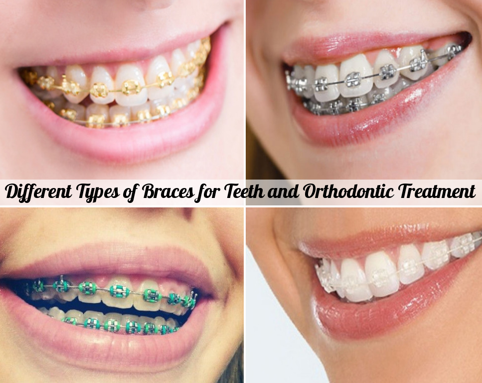 The Many Different Types of Teeth – Cirocco Dental Center